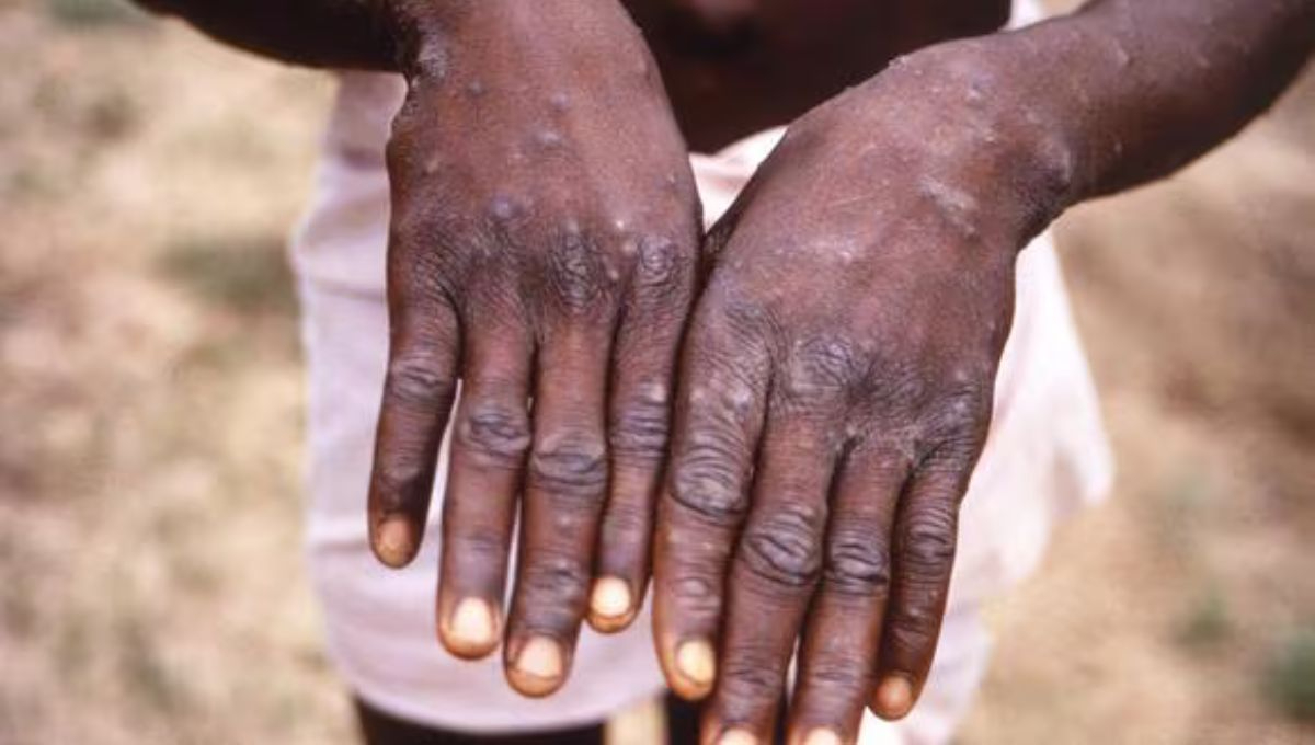 África declara emergencia de salud pública por brote de mpox, con una nueva cepa más mortal y contagiosa