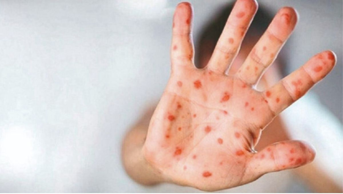 En México no se ha registrado ningún contagio de la variante más letal de mpox