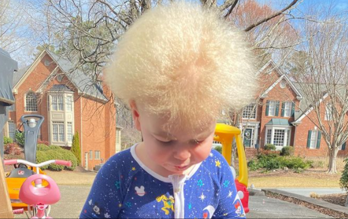 Recientemente  se descubrió que el síndrome de cabello de coco, es causado por mutaciones en uno de 3 genes, PADI3, TGM3 y TCHH