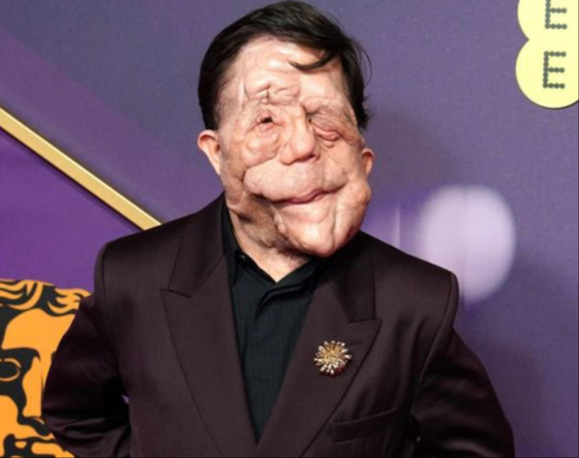 Adam Pearson asistió a los BAFTA por su papel en 'A Different Man'