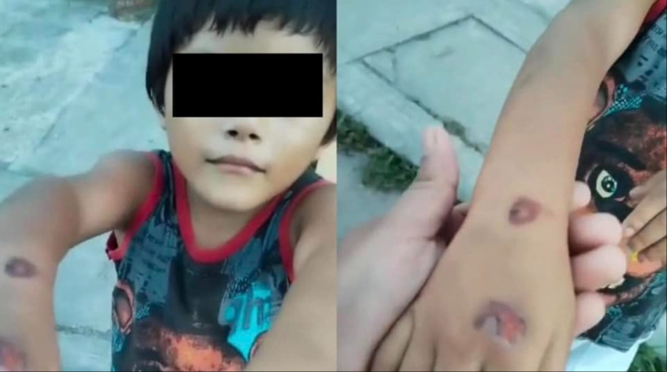 Niño de 5 años denunció en video que su padre lo quemaba, fue rescatado