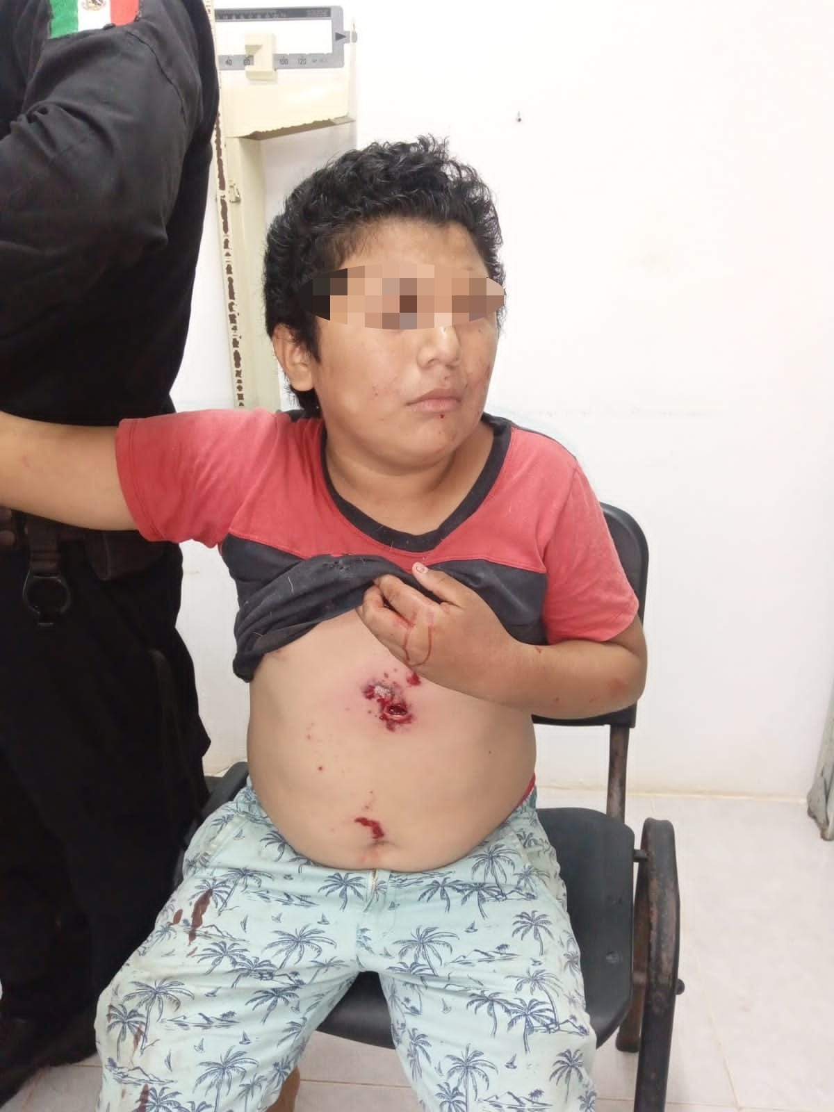 Otro de los niños resultó con heridas tras intentar prender una "palomita"