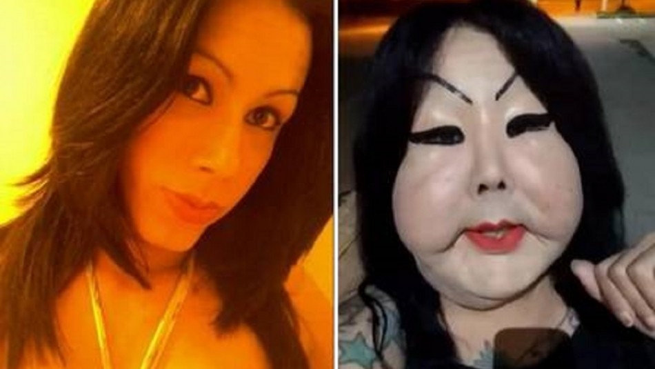 Una mujer transexual, identificada como Juju Oliveira, de 30 años, se encuentra con el rostro deformado luego de inyectarse silicona industrial