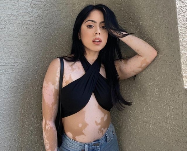 El vitiligo es una enfermedad que afecta a 1 de cada 100 personas