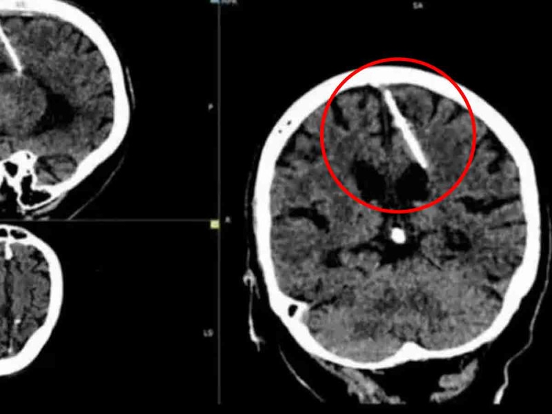 Mujer rusa de 80 años descubre que vive con una aguja en el cerebro desde que era bebé