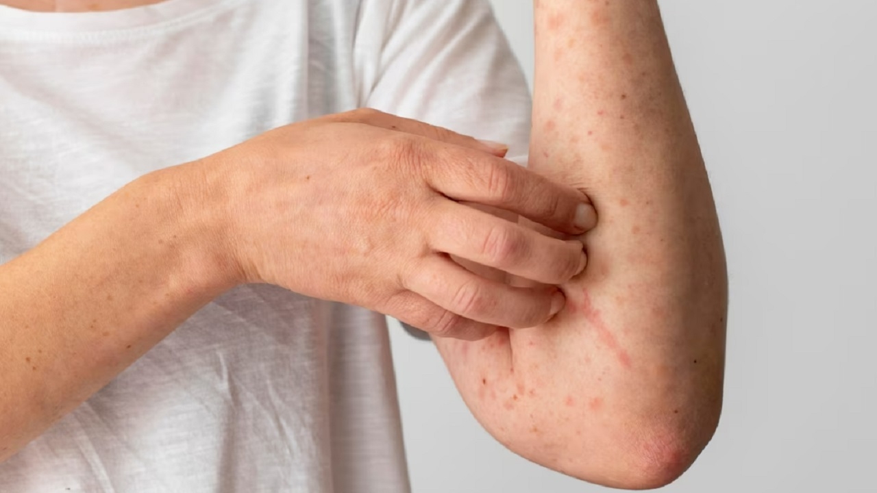 ¿Cómo evitar el contagio por lepra?