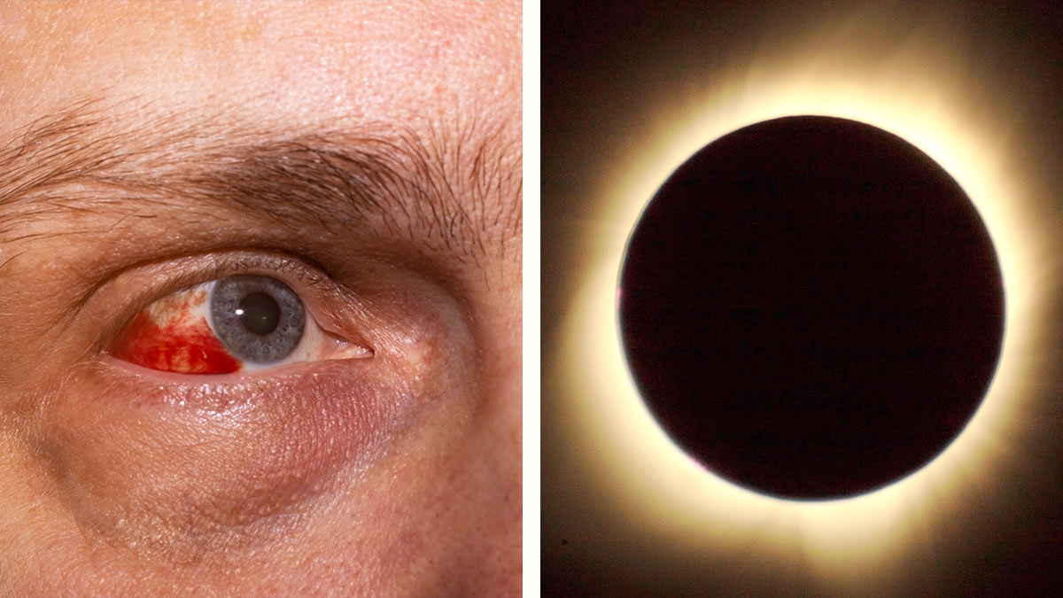 Internautas comparten videos de daños en los ojos tras ver el eclipse solar 2024